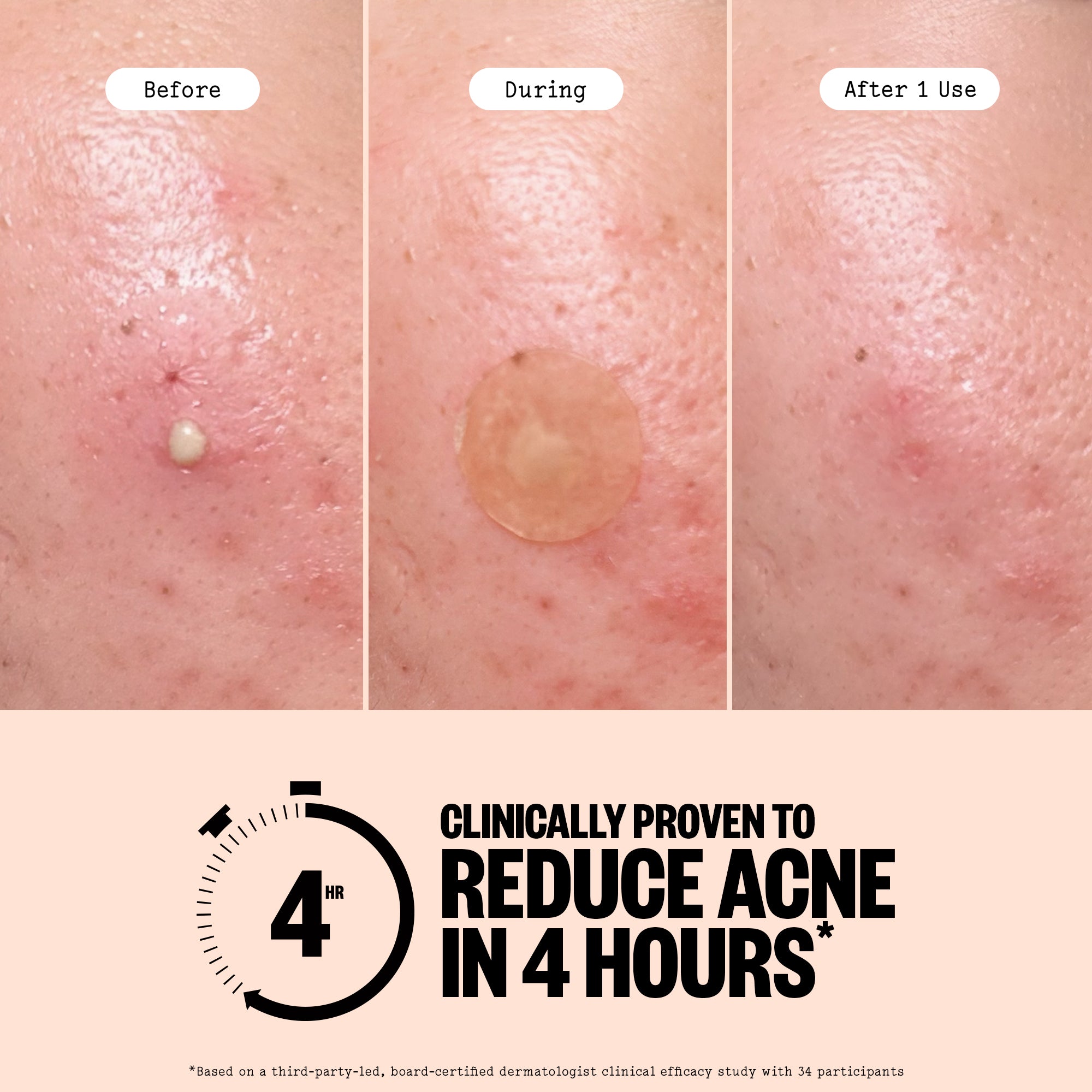 Acne Treatment Dots